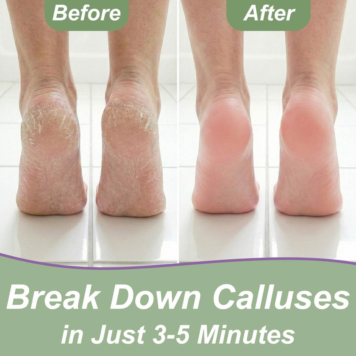 Experience the transformation with Extra Strength Callus Remover Gel, specially curated by Curat Cart for smooth, soft feet.