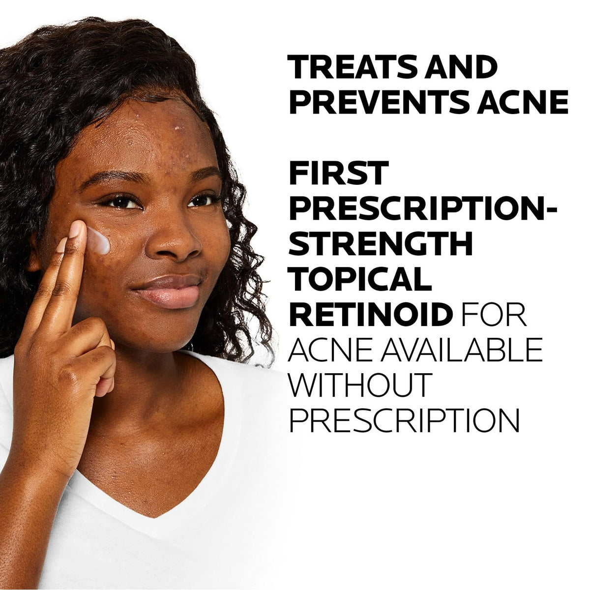 La Roche-Posay Effaclar Adapalene Gel offers prescription-strength acne treatment without a prescription, promoting clear skin.