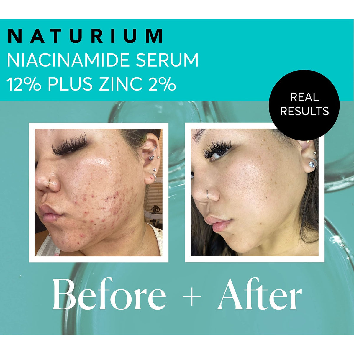 Transform your skin with Naturium Niacinamide Serum Plus Zinc. Visible improvement in acne marks and texture.
