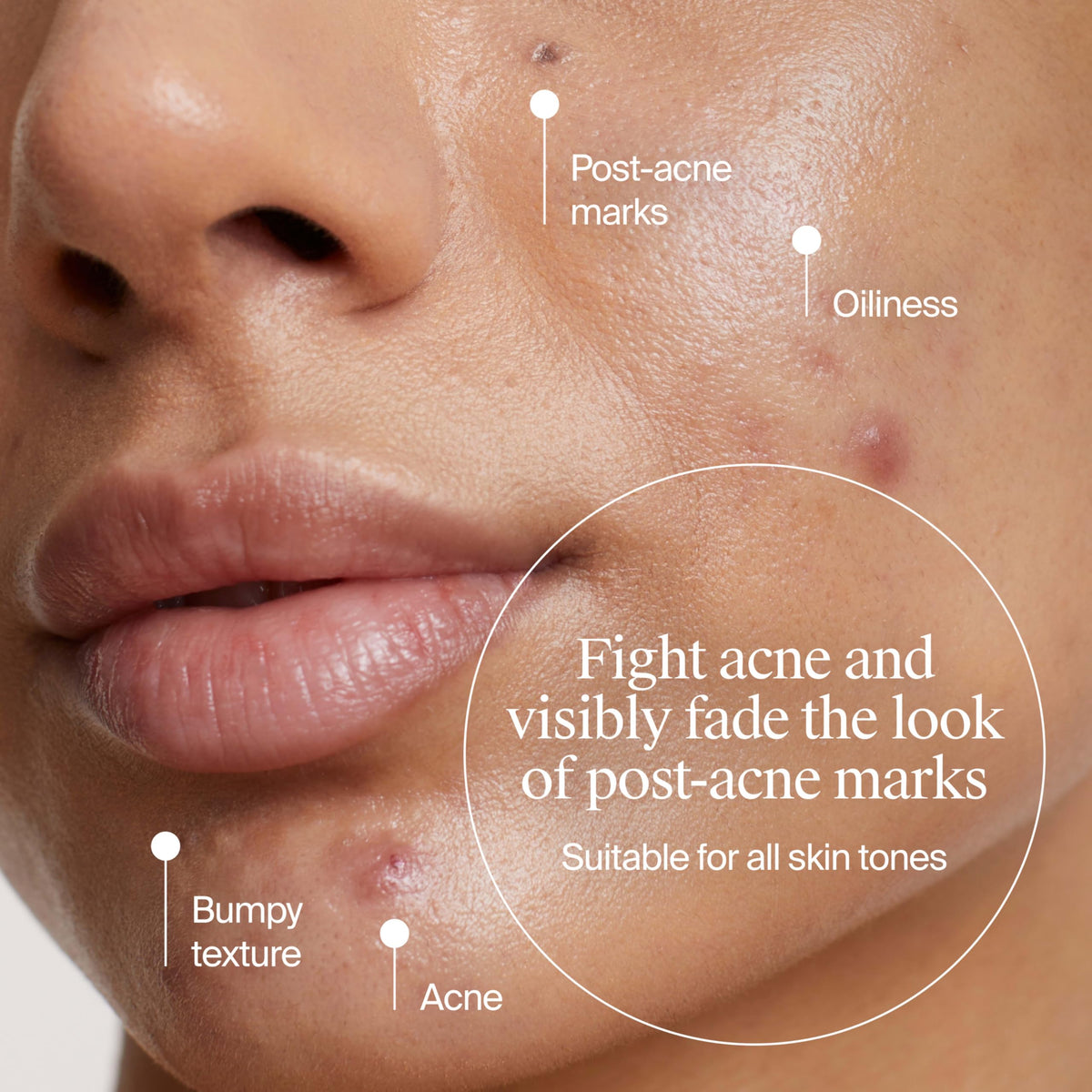 Neutrogena Evenly Clear Acne Cleanser visibly reduces acne and post-acne marks. High-quality packaging available at Curat Cart.