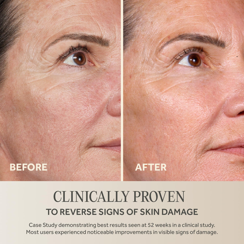 Before and after showing noticeable skin improvement with No7 Future Renew, clinically proven to reverse signs of damage.