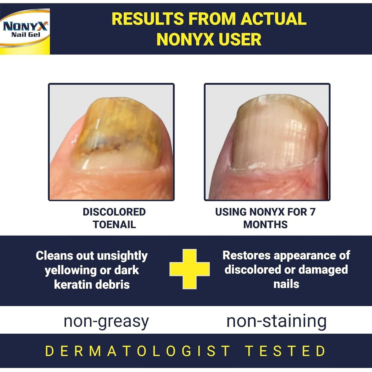 Transform your nails with NONYX Fungal Nail Gel. Available in India, order online for effective results today.