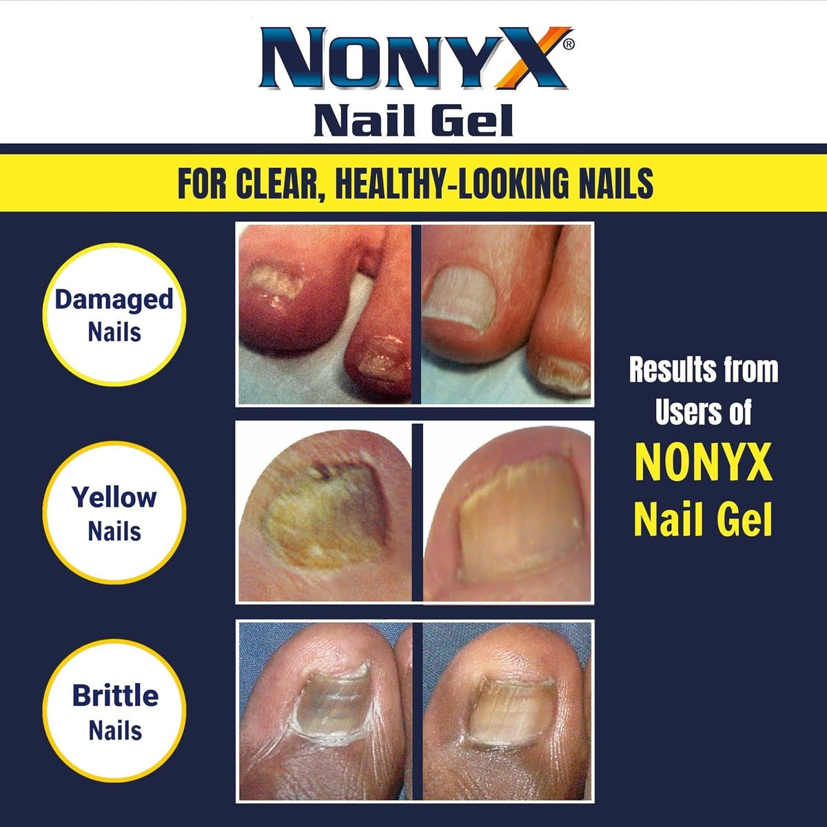 NONYX Fungal Nail Gel showcases before and after images of damaged, yellow, and brittle nails, highlighting effective results.