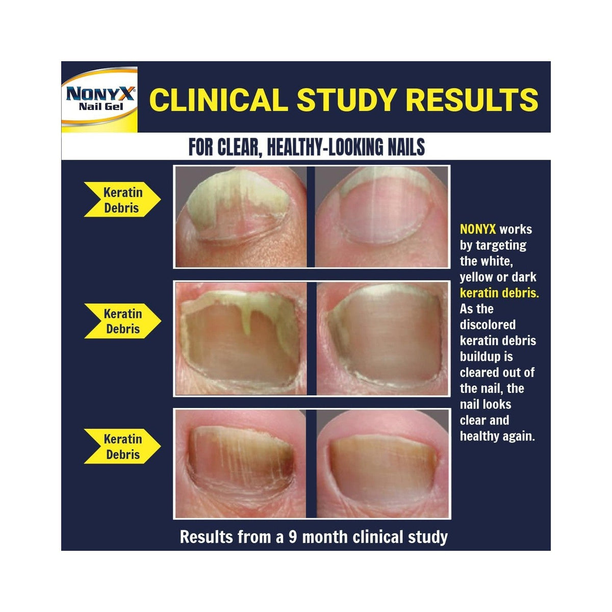 NONYX Fungal Nail Gel: Premium imported solution targeting keratin debris for visibly healthier nails.