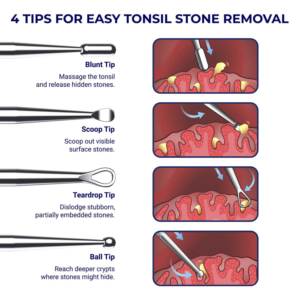 Discover the Oravix Tonsil Stone Remover Tool with exclusive tips for effective removal, specially curated by Curat Cart.