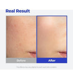 Before and after images showcase the effectiveness of Pair Acne Cream for Face, highlighting clearer skin. 100% genuine product.
