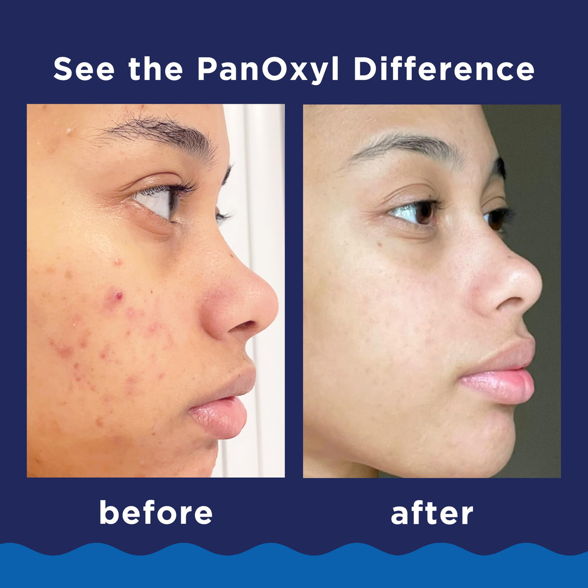 Experience visible results with PanOxyl Benzoyl Peroxide Acne Wash. Verified by CuratCart for trusted quality.