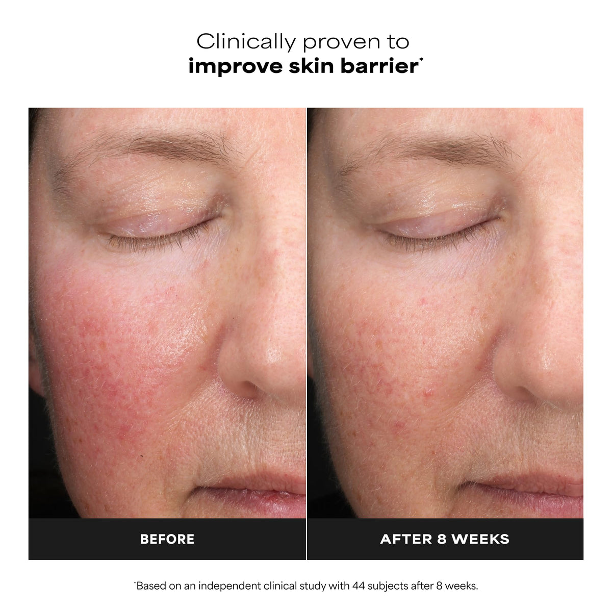 Visible improvement in skin barrier after using Paula's Choice Mandelic Lactic Acid Exfoliant. Verified by CuratCart.