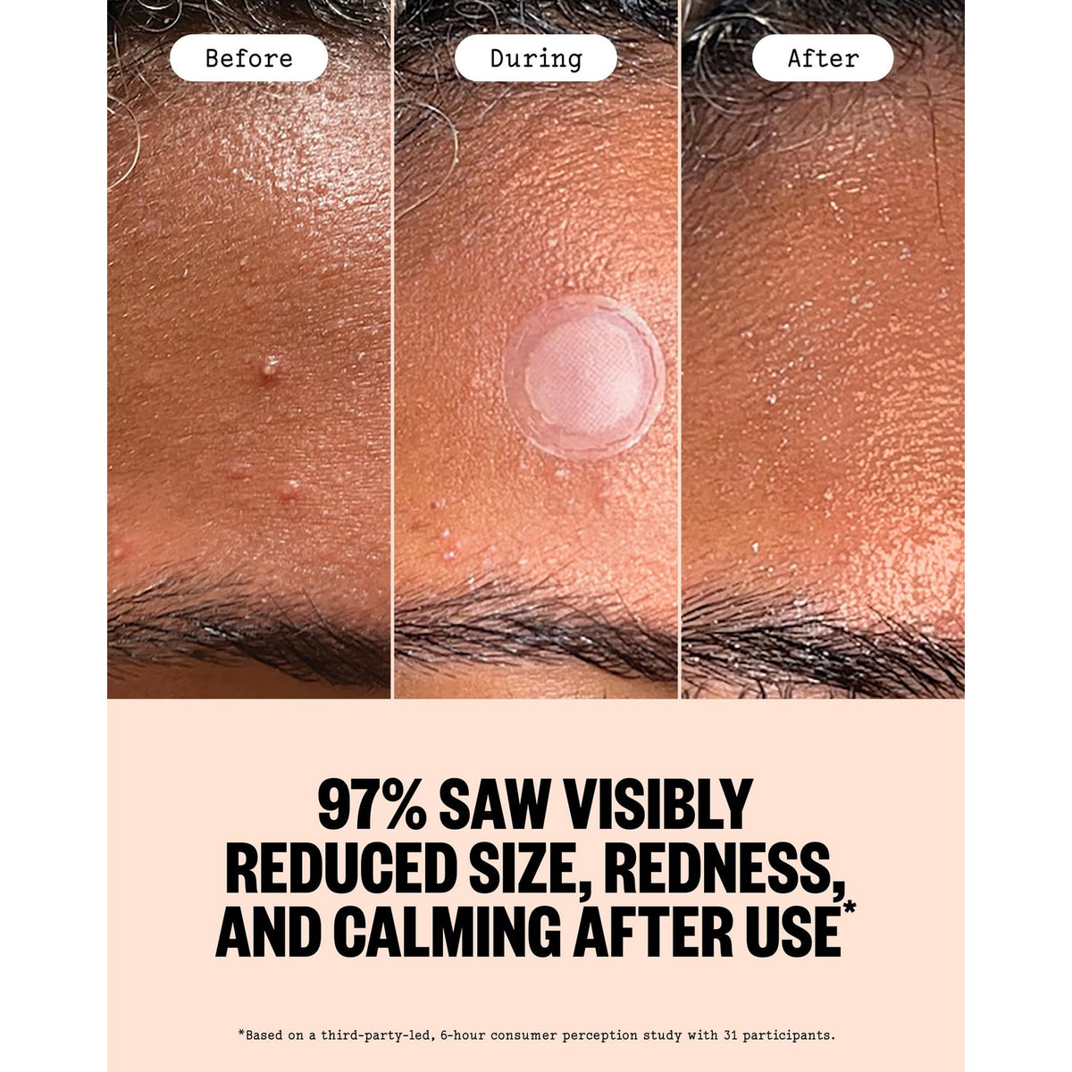 Transform your skin with Peace Out Acne Microneedling Dots, specially curated by Curat Cart for effective acne treatment.