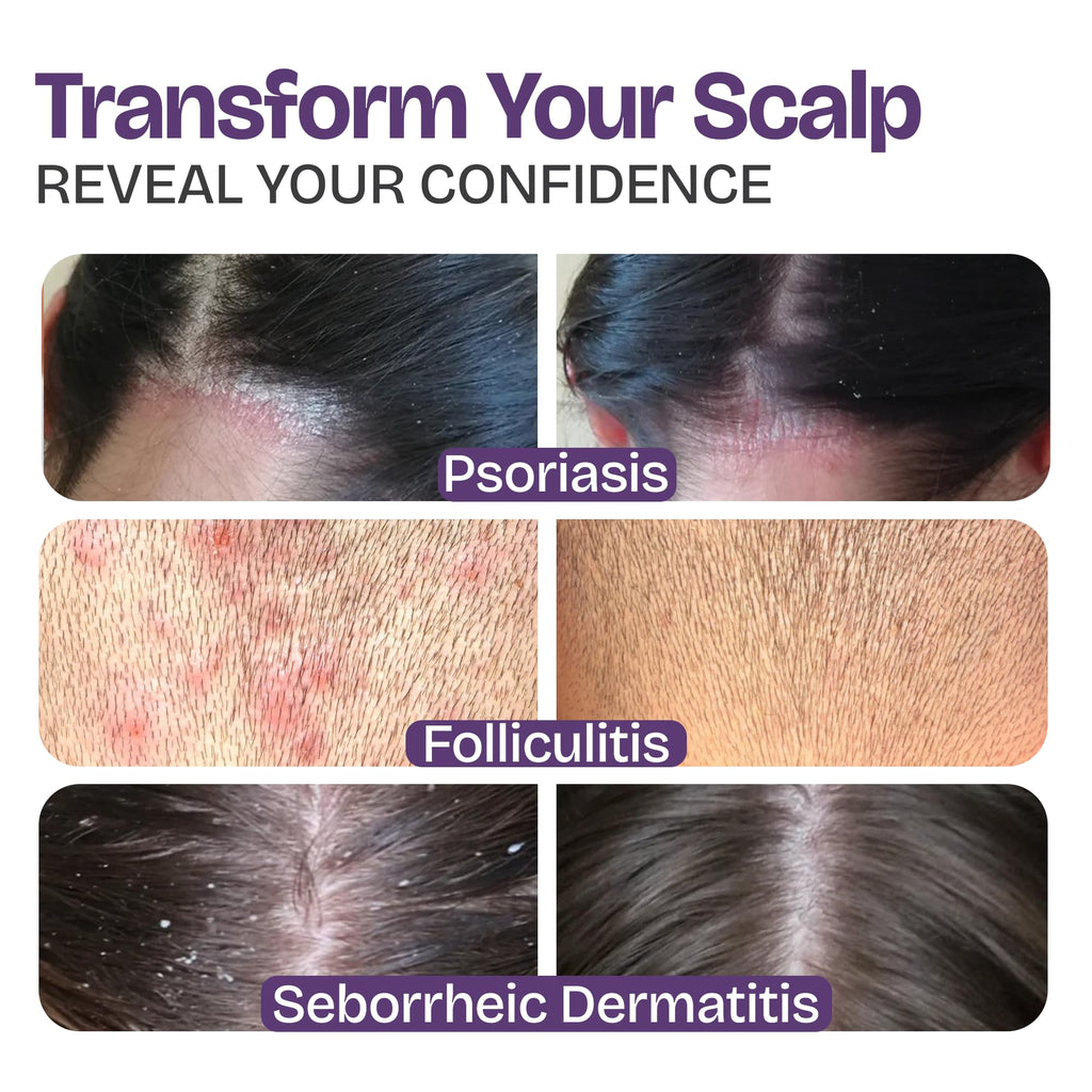 Transform your scalp with our Psoriasis Shampoo, specially curated by Curat Cart for effective relief and confidence.