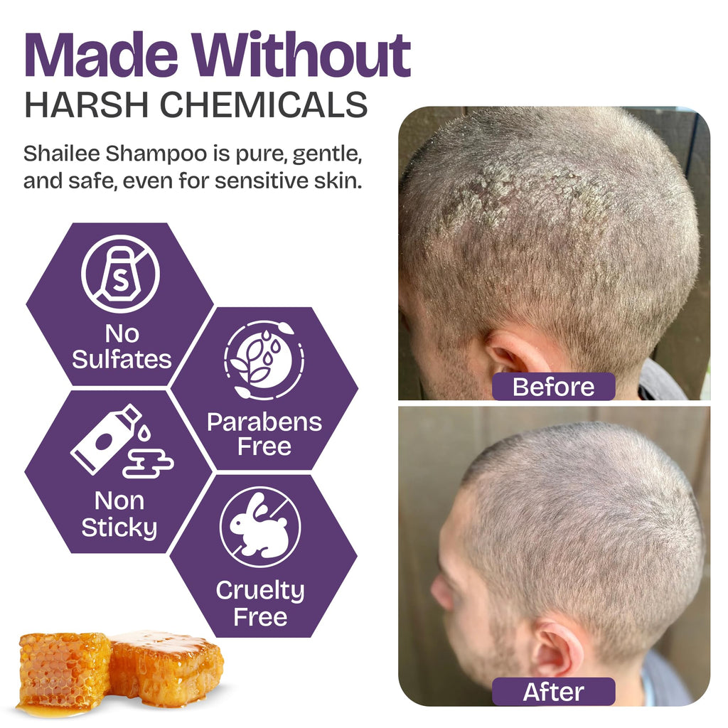 Psoriasis Shampoo with Scalp Scrubber in official packaging, showcasing effective results for sensitive skin. Available at Curat Cart.