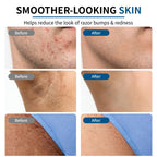 Before and after images demonstrating the effectiveness of Razor Bumps Ingrown Hair Treatment for smoother-looking skin.
