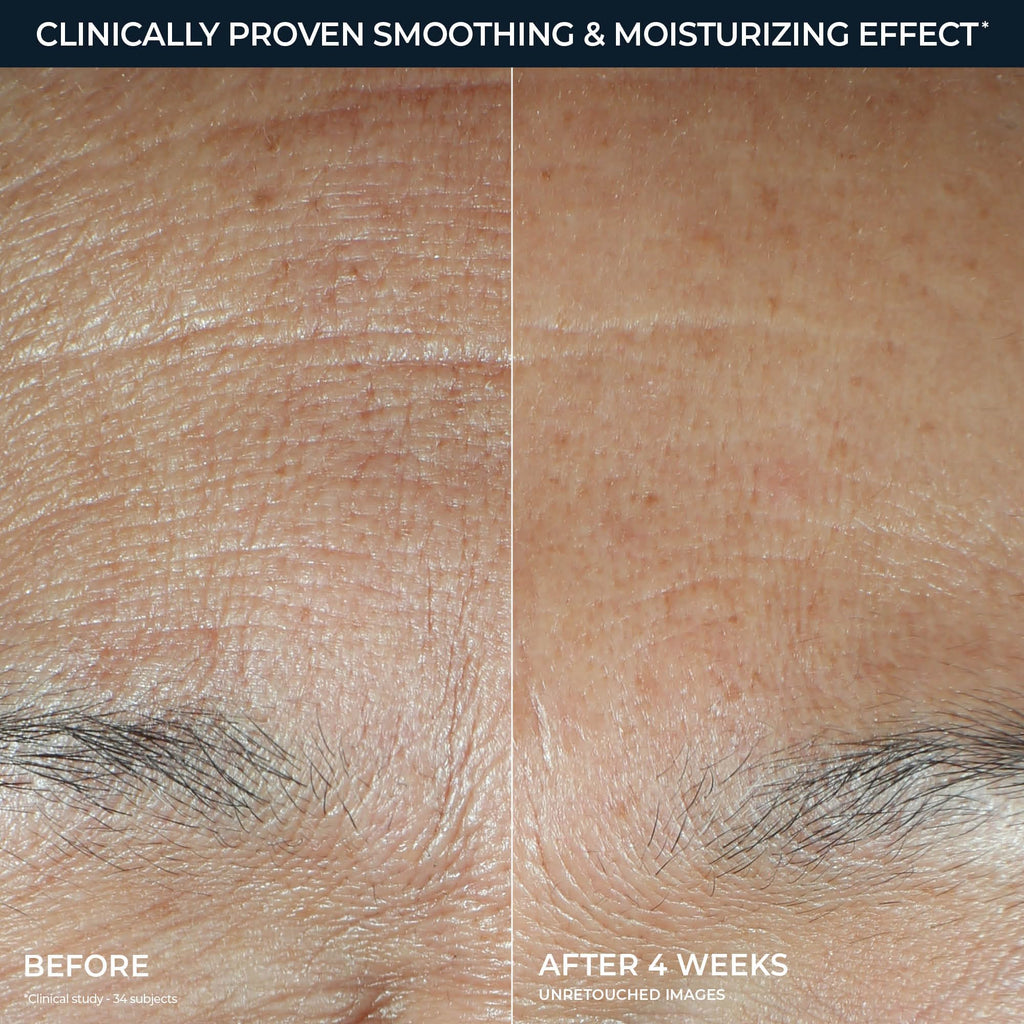 Side-by-side comparison showing skin texture before and after using RoC Hyaluronic Acid Night Serum Capsules for four weeks.