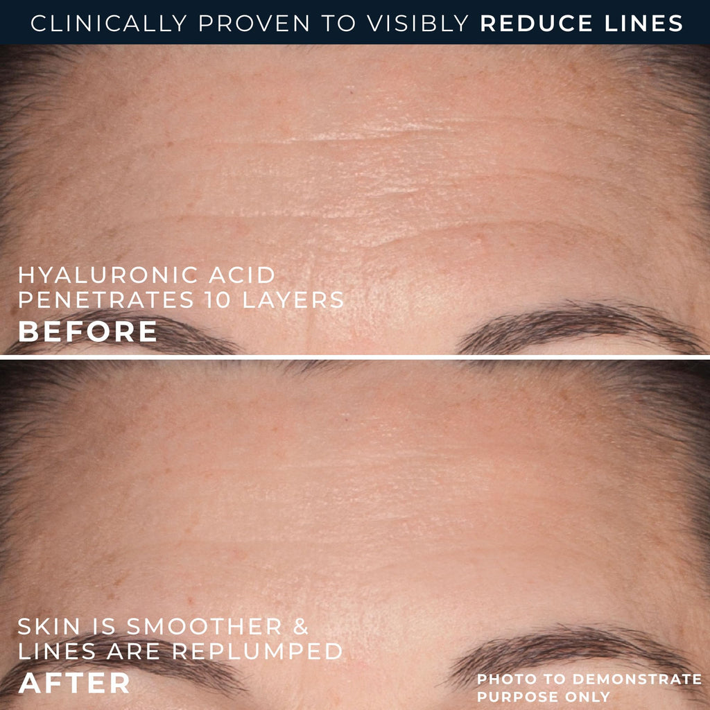 Before and after images showing RoC Hyaluronic Acid's effect on skin, visibly reducing lines and improving smoothness.