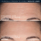 Before and after images showing RoC Hyaluronic Acid's effect on skin, visibly reducing lines and improving smoothness.