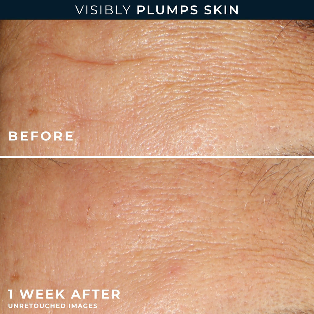Before and after images show visibly plumper skin in just one week with RoC Hyaluronic Acid Night Serum Capsules, a global favorite.