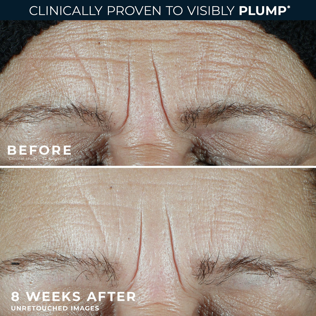 Image shows before and after results of RoC Multi Correxion 1.5% Pure Hyaluronic, highlighting visible plumpness in skin.