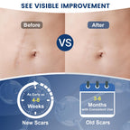 Experience visible improvement with Rvlaim Advanced Silicone Scar Gel, specially curated by Curat Cart for effective scar treatment.
