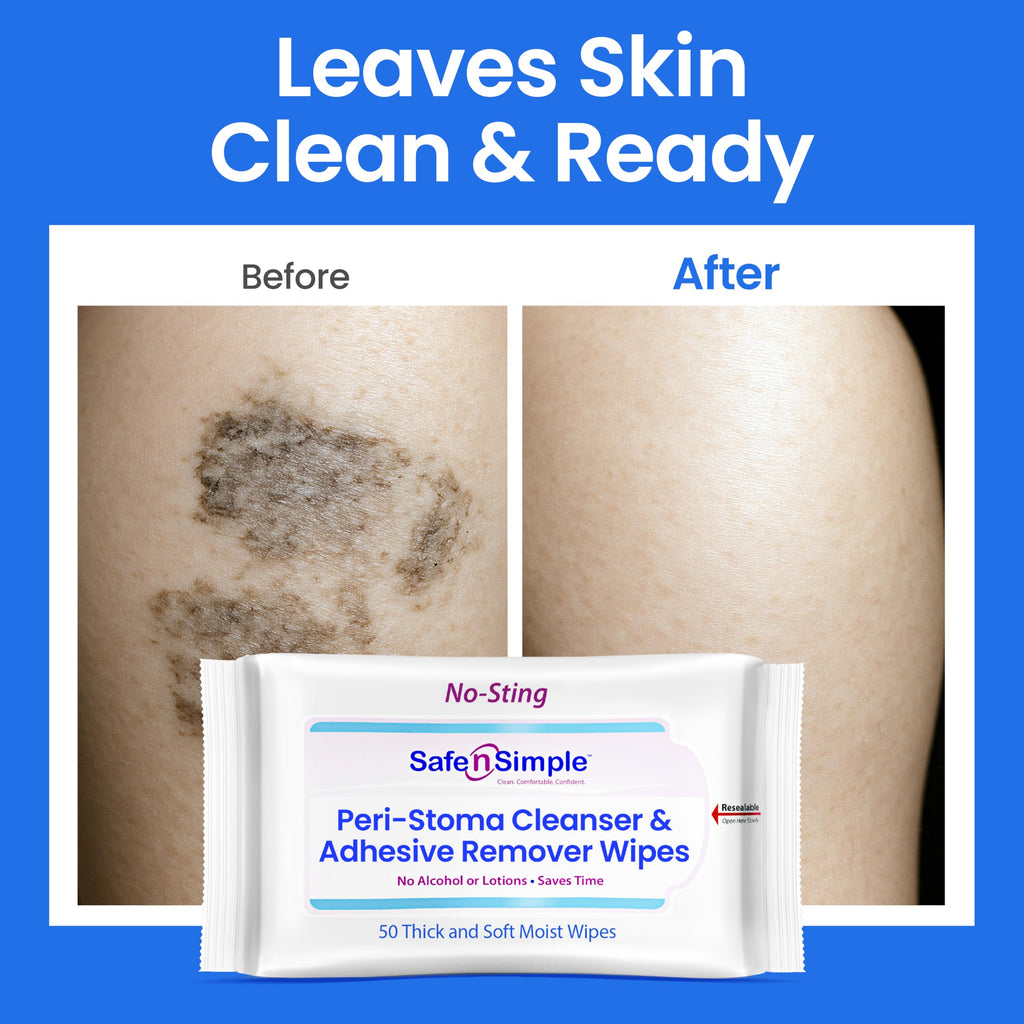 Safe n’ Simple Adhesive Remover Wipes effectively cleanse and prepare skin. 100% Authentic, available at Curat Cart.