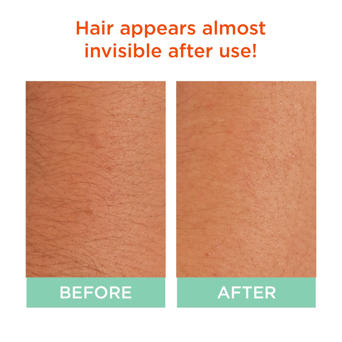 Sally Hansen Bleach Cream shows dramatic results; hair appears nearly invisible after use, enhancing skin tone.