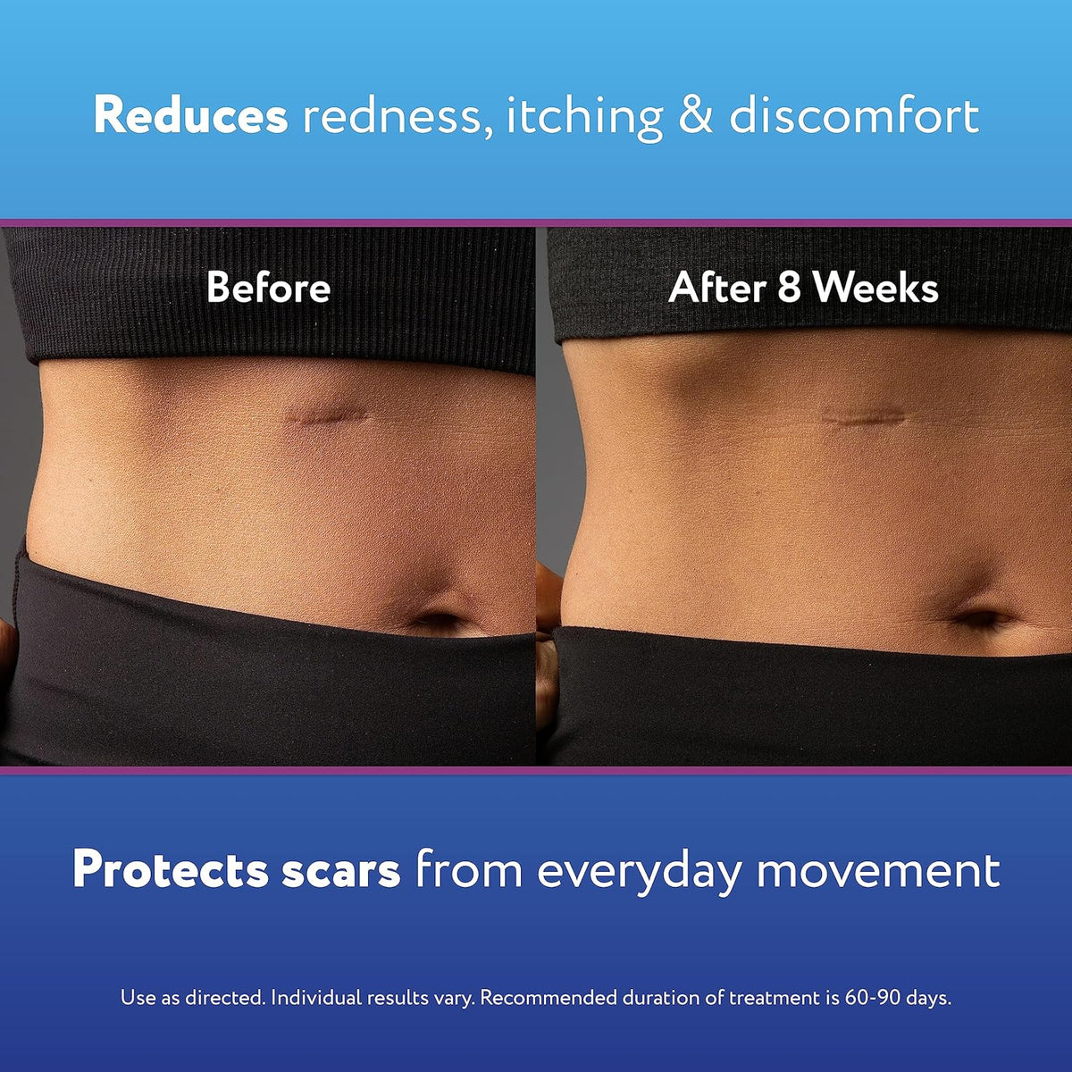 ScarAway Medical-Grade Silicone Scar Gel shows impressive results after 8 weeks, minimizing scars effectively.
