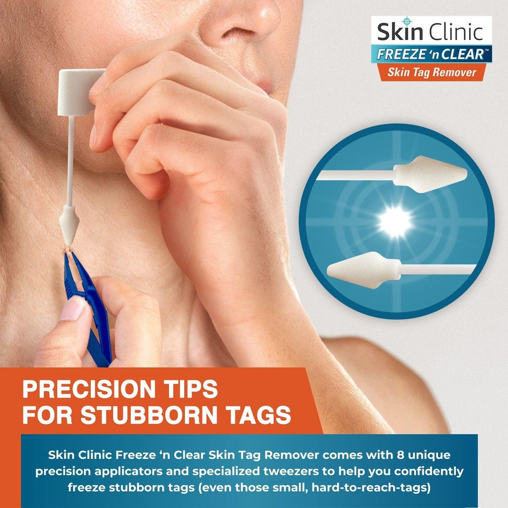 Skin Clinic Skin Tag Remover features precision tips for stubborn tags, perfect for effective removal. Available at Curat Cart.