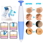 Discover the Skin Tag Remover Device for effective skin care. 100% Authentic, available in India at Curat Cart.
