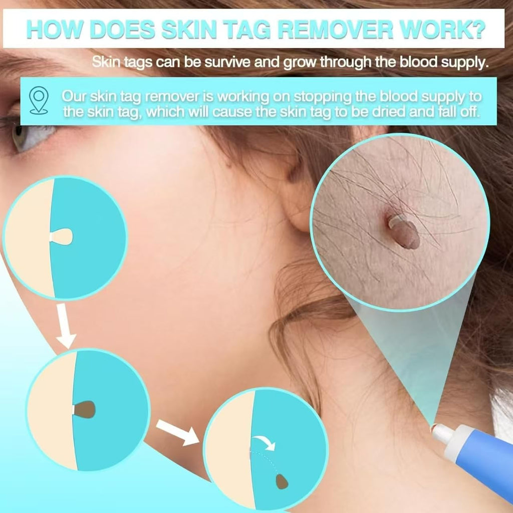Discover the effective Skin Tag Remover Device from Curat Cart, designed to safely eliminate skin tags with ease. Perfect for daily use.