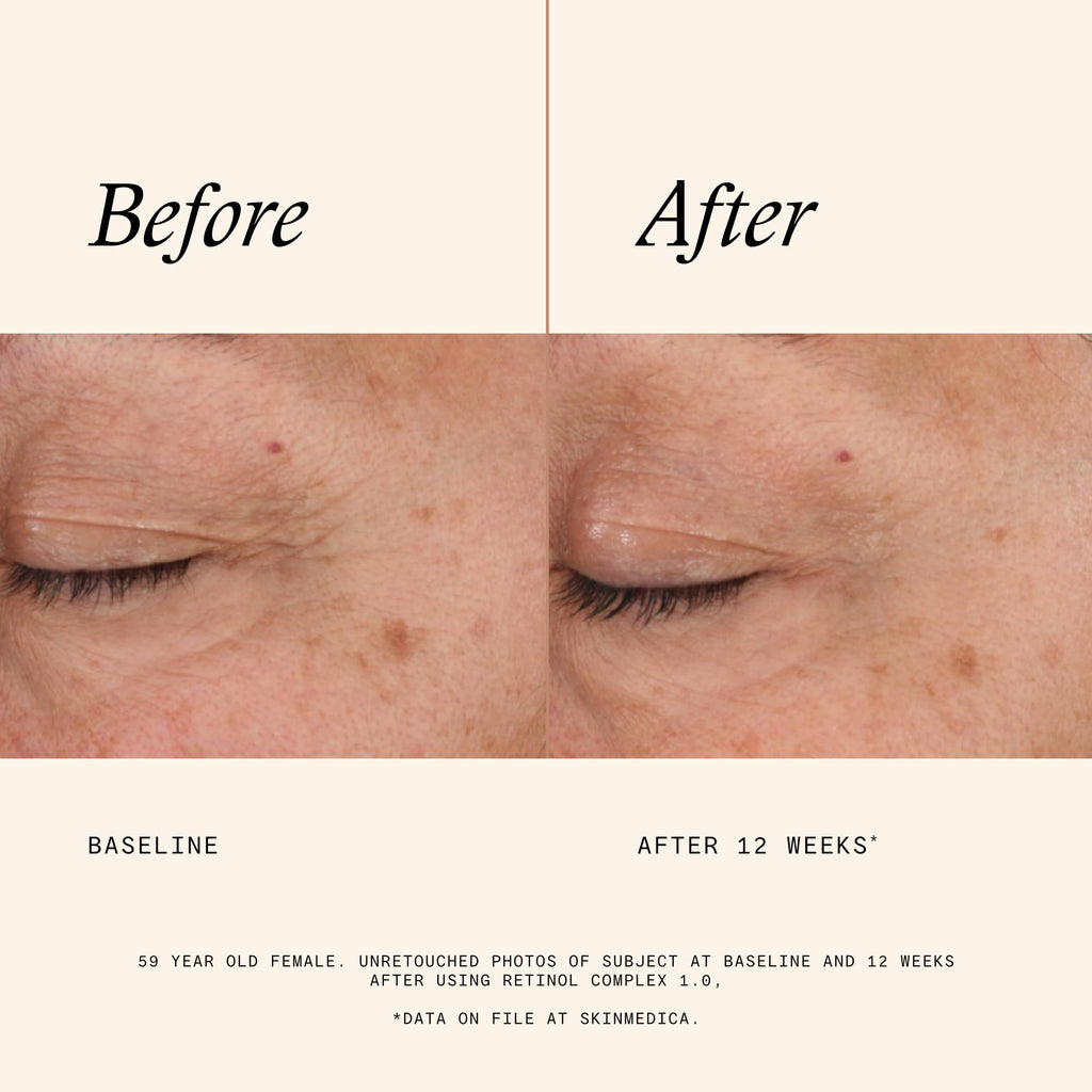 Before and after images of eye area showing improvement after using SkinMedica Retinol Serum 1.0. Verified by CuratCart.