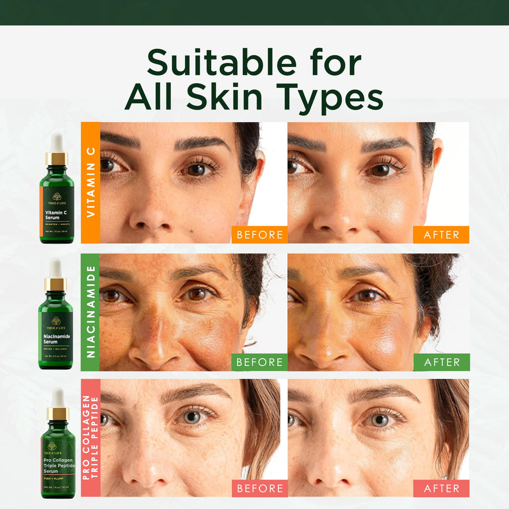 Before and after results of Tree of Life Face Serum, suitable for all skin types. Available in India. Order online now!